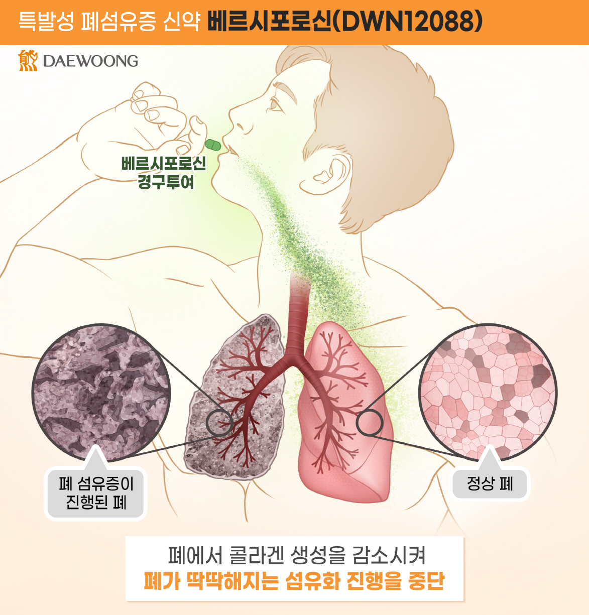 베르시포로신 작용 기전. 사진=대웅제약.