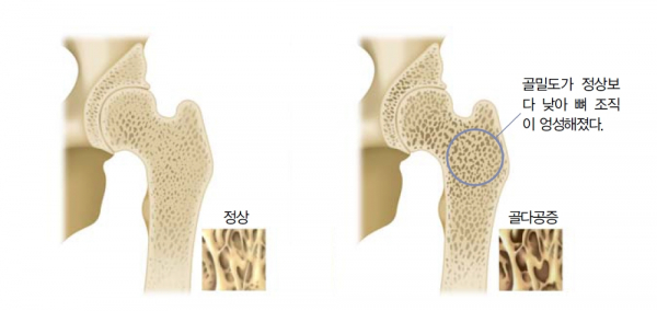 정상 뼈(왼쪽)와 골다공증이 있는 뼈. 출처=자생한방병원