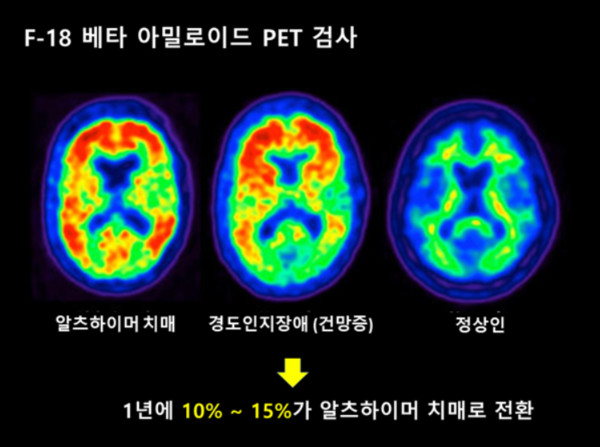 아밀로이드 PET 검사(그림에서 빨간 부분이 대뇌 피질에 침착한 베타아밀로이드). 출처=고대안암병원