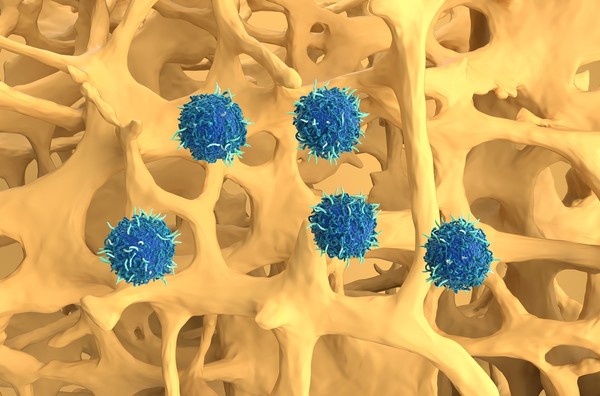 골다공증에 대해 세포 치료의 일종인 카티(CAR-T) 치료가 되고 있는 모습. 사진=셔터스톡